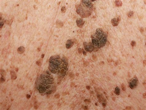 These are benign flat, raised, or pedunculated lesions, varying in colour from yellow to dark brown. . Seborrheic keratosis nhs pictures